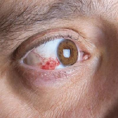 ایجاد زخم و اسکار در اثر  استفاده از لنز سخت یا  در قرنیهRGP